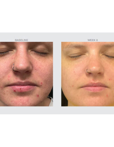 Acne Calming Salicylic Serum