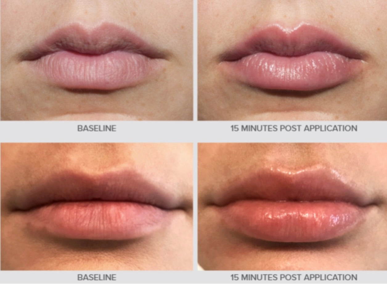 Lip Plumping HA Treatment